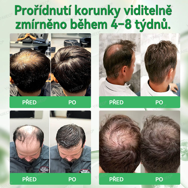 🍌𝐘𝐀𝐈𝐈𝐄𝐎® 𝑭á𝒋𝒅𝒂𝒍𝒐𝒎𝒎𝒆𝒏𝒕𝒆𝒔 𝑴𝒊𝒌𝒓𝒏💛 𝑹𝒆𝒏𝒅𝒔𝒛𝒆𝒓 Hluboce působící blokování DHT, reaktivace vlasových folikulů a viditelný růst vlasů