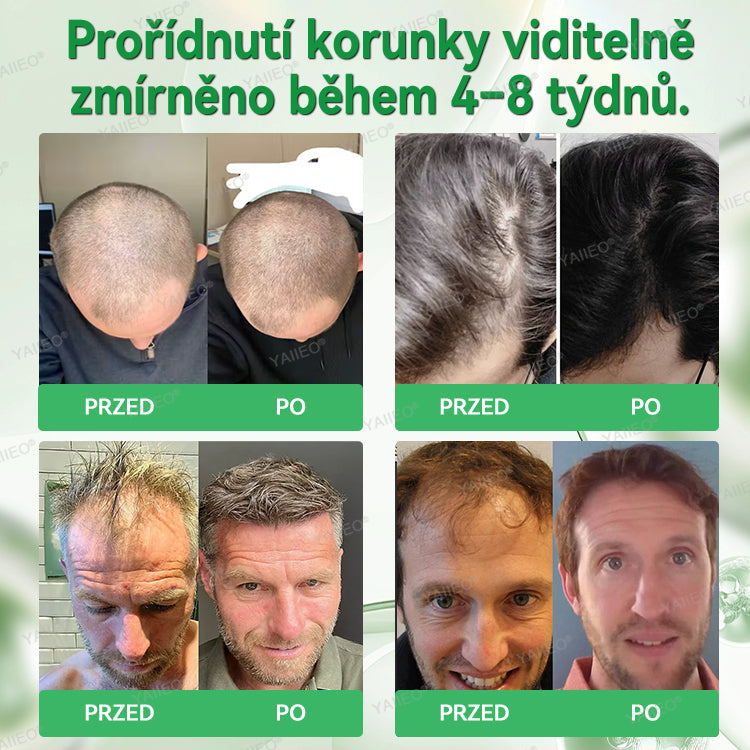 🍌𝐘𝐀𝐈𝐈𝐄𝐎® 𝑭á𝒋𝒅𝒂𝒍𝒐𝒎𝒎𝒆𝒏𝒕𝒆𝒔 𝑴𝒊𝒌𝒓𝒏💛 𝑹𝒆𝒏𝒅𝒔𝒛𝒆𝒓 Hluboce působící blokování DHT, reaktivace vlasových folikulů a viditelný růst vlasů