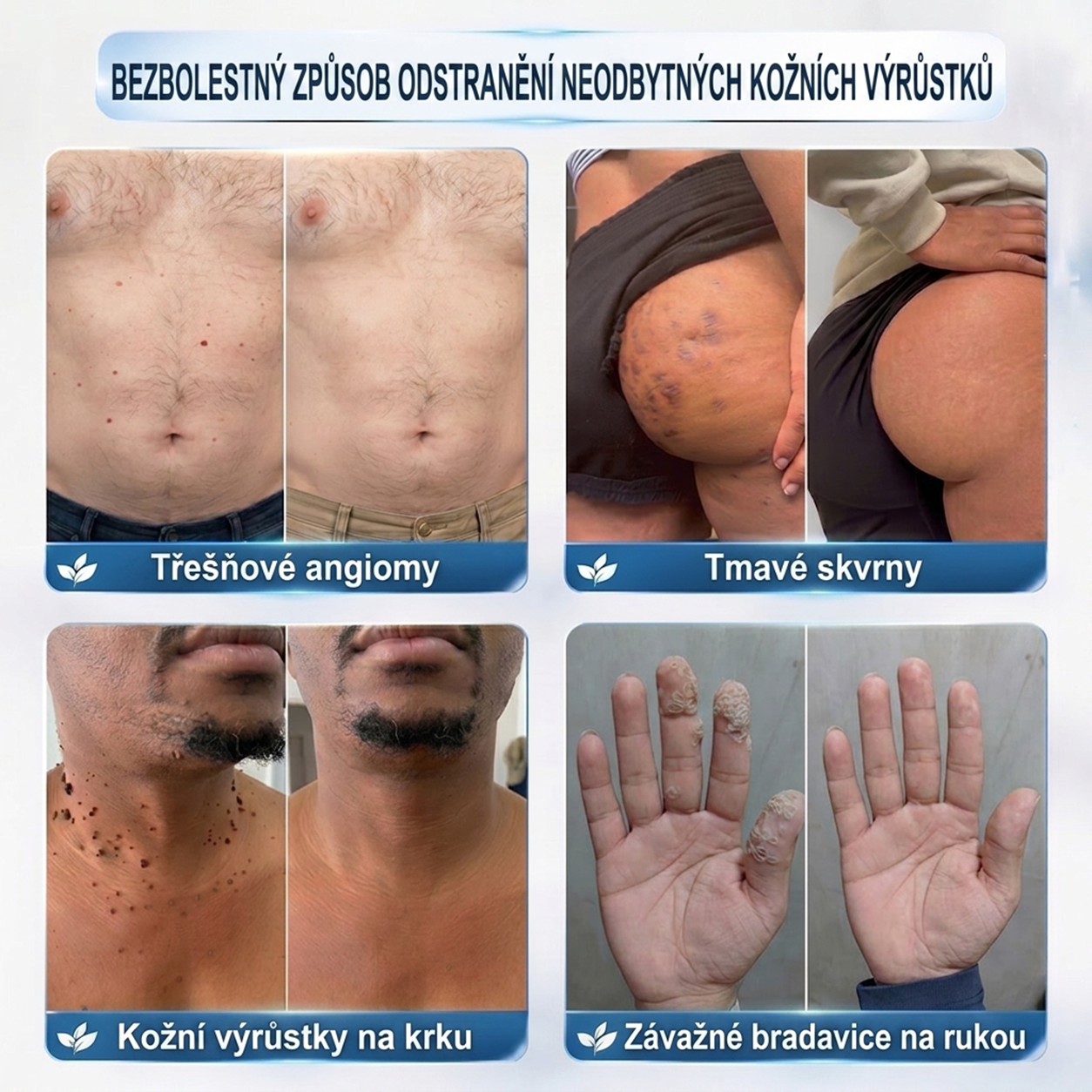 🍃PuraCure® 👩‍⚕️ 𝟕denní Pero na Odstranění Kožních Výrůstků a Skvrn – Bezbolestné Odstranění bez Jizev, Profesionální Roller aplikátor