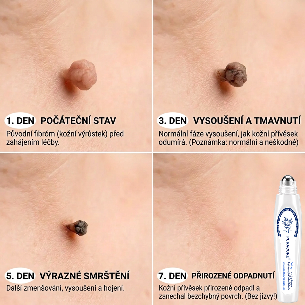 🍃PuraCure® 👩‍⚕️ 𝟕denní Pero na Odstranění Kožních Výrůstků a Skvrn – Bezbolestné Odstranění bez Jizev, Profesionální Roller aplikátor