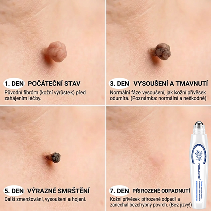🍃PuraCure® 👩‍⚕️ 𝟕denní Pero na Odstranění Kožních Výrůstků a Skvrn – Bezbolestné Odstranění bez Jizev, Profesionální Roller aplikátor